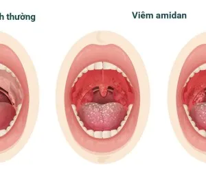 Amidan thường được bác sĩ cắt bỏ khỏi cơ thể bệnh nhân, phải chăng nó không có vai trò gì