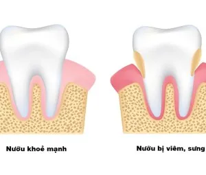 Vì sao bị sâu răng?