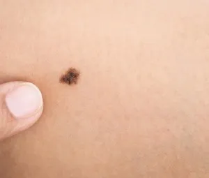 Vì sao có nốt ruồi?