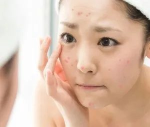 Vì sao mặt thanh niên dễ phát sinh nốt mụn?