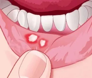 Vì sao miệng vết thương gặp phải chất mặn thì dễ xót?