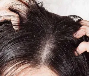 Vì sao một số người đầu có gầu nhiêu?