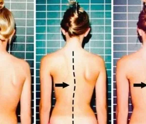 Vì sao thanh, thiếu niên dễ bị vẹo cột sống?
