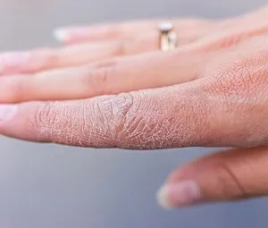Vì sao vào mùa đông, vành tai và tay một số người hay bị nứt nẻ?