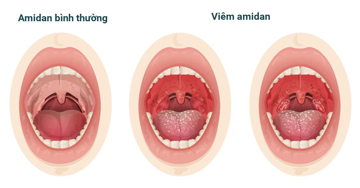 Amidan thường được bác sĩ cắt bỏ khỏi cơ thể bệnh nhân, phải chăng nó