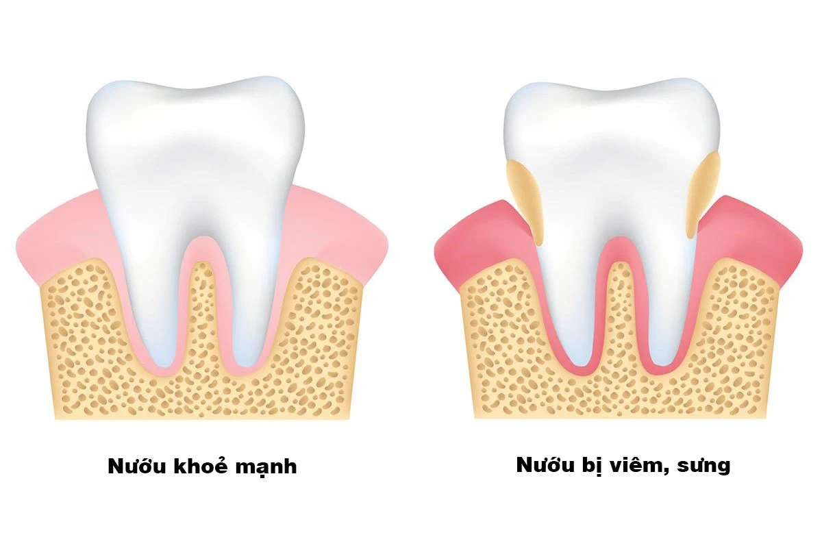Vì sao bị sâu răng? – Kho truyện cổ tích