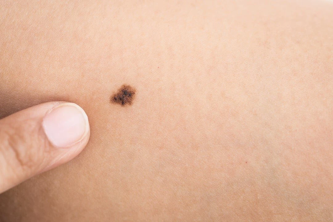 Vì sao có nốt ruồi? – Kho truyện cổ tích