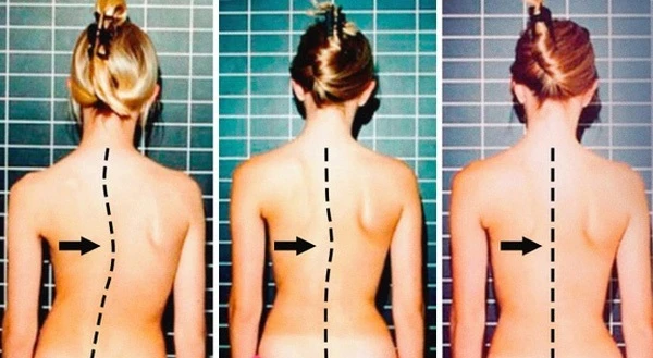 Vì sao thanh, thiếu niên dễ bị vẹo cột sống?